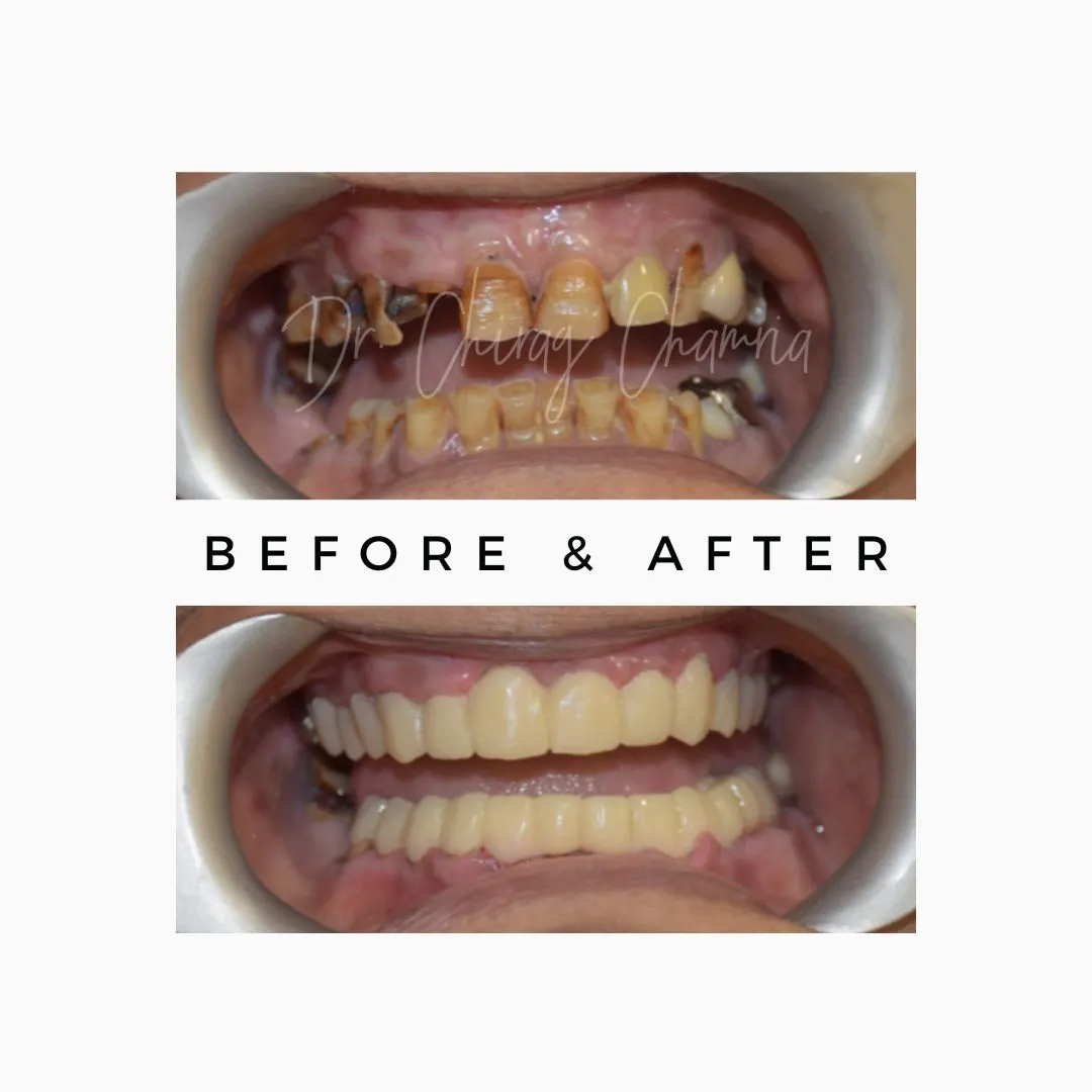 Full Mouth Implant,full mouth Implants Mumbai,Implant Specialist Kandivali,Implant Surgeon Mumbai,Full mouth rehabilitation,full mouth makeover