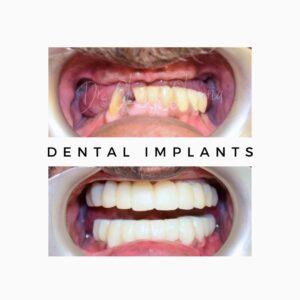 Dental Implant Before and After