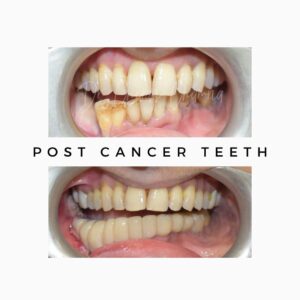 Teeth after Cancer - Before and After