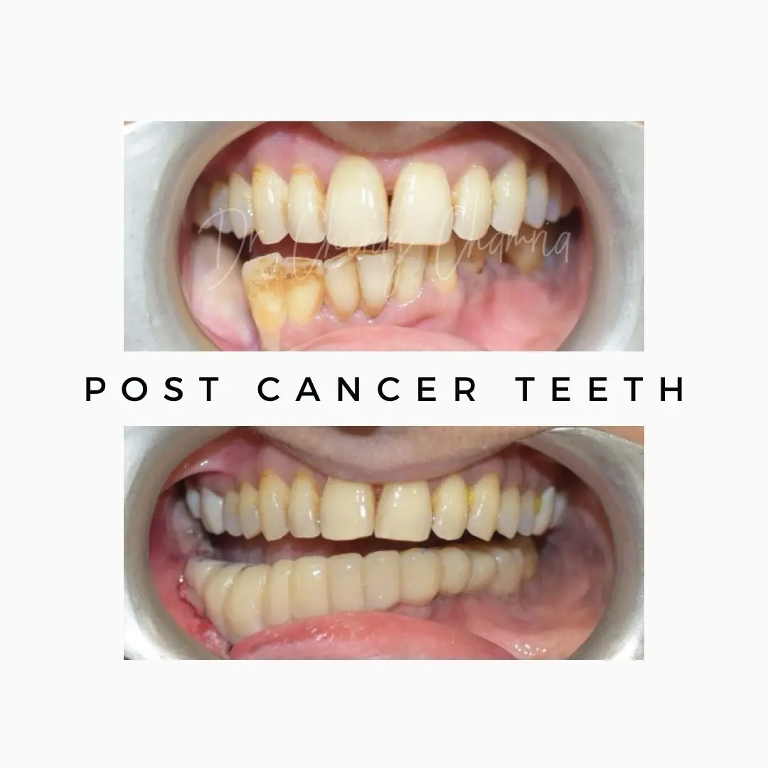 oral cancer,cancer treatment,Oral Cancer Surgeon Mumbai,Jaw Reconstruction After Cancer Mumbai,Cancer Rehabilitation Dentist Kandivali,Teeth after cancer surgery Mumbai,CAJTeeth,oral cancer teeth