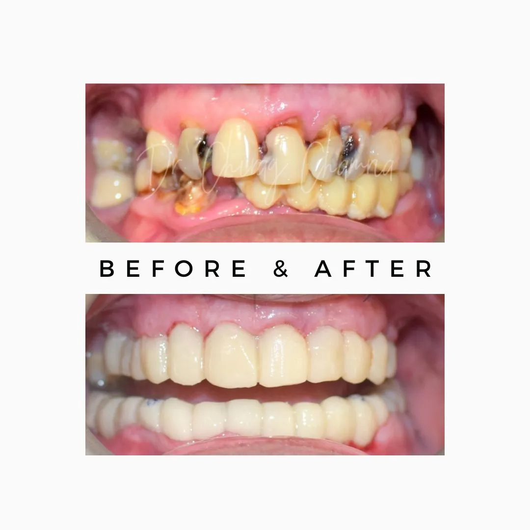 Saving Natural Teeth