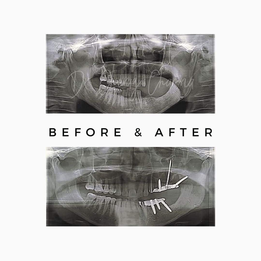 oral cancer,cancer treatment,Oral Cancer Surgeon Mumbai,Jaw Reconstruction After Cancer Mumbai,Cancer Rehabilitation Dentist Kandivali,Teeth after cancer surgery Mumbai,CAJTeeth,oral cancer teeth