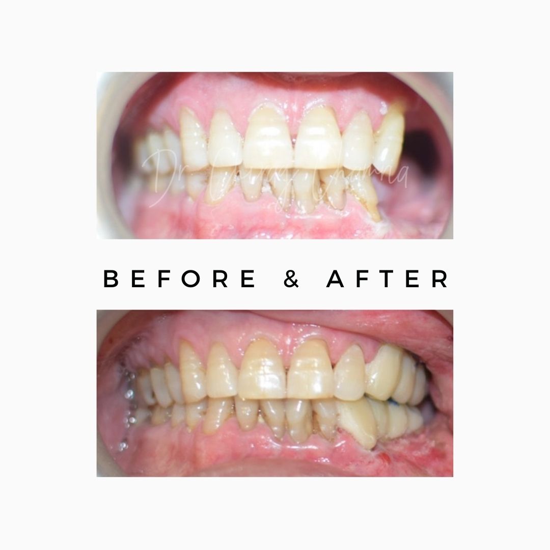 oral cancer,cancer treatment,Oral Cancer Surgeon Mumbai,Jaw Reconstruction After Cancer Mumbai,Cancer Rehabilitation Dentist Kandivali,Teeth after cancer surgery Mumbai,CAJTeeth,oral cancer teeth