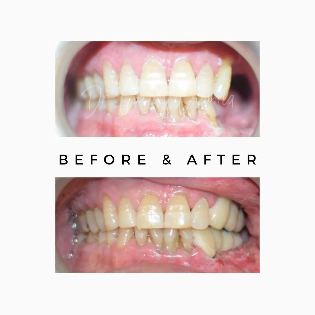 Cancer Affected Jaw 1 Cancer rehabilitation of teeth in one day