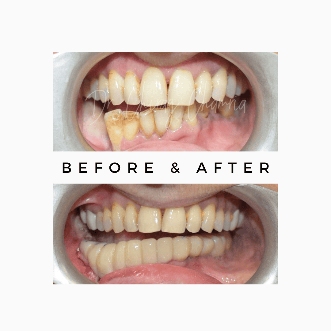 oral cancer,cancer treatment,Oral Cancer Surgeon Mumbai,Jaw Reconstruction After Cancer Mumbai,Cancer Rehabilitation Dentist Kandivali,Teeth after cancer surgery Mumbai,CAJTeeth,oral cancer teeth