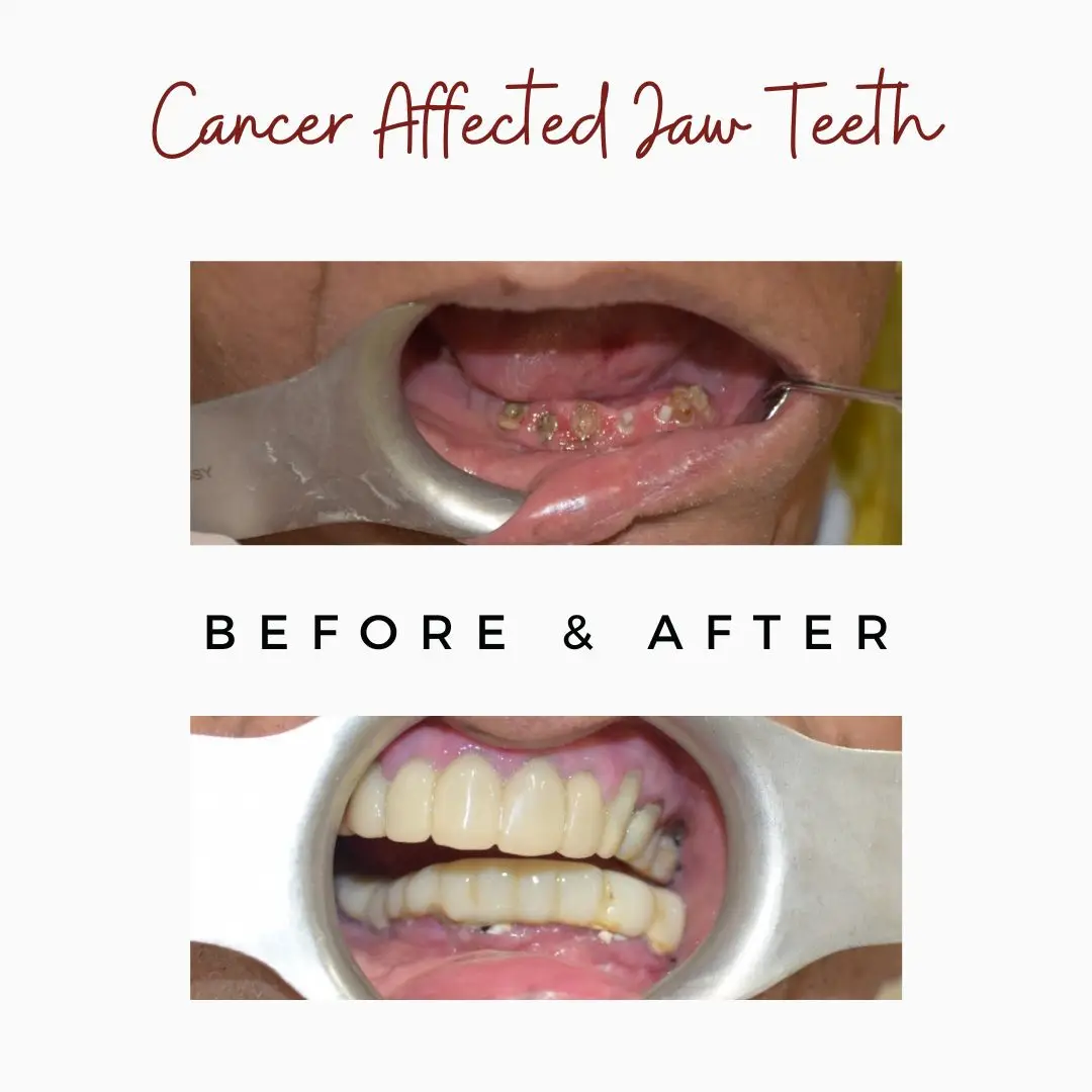oral surgery,orthognathic surgery,Jaw Surgery Specialist Mumbai,Underbite surgery Mumbai,jaw alignment surgery,wisdom tooth,dental extraction,jaw pain in mumbai,oral surgeon,oral cyst