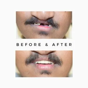 Cleft surgery by Oral surgeon in mumbai