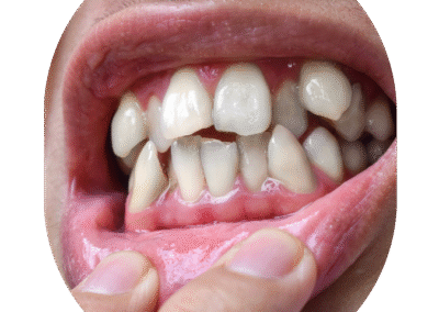 Crooked Teeth - Cosmetic Dentist