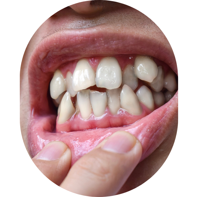 jaw pain,TMJ Treatment Mumbai,tmj specialist,TMJ Pain Specialist Kandivali,Jaw Pain Treatment Mumbai,Clicking jaw treatment Kandivali,Facial pain specialist,tekscan