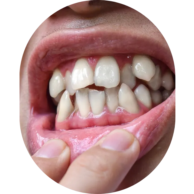 Crooked Teeth Crooked Teeth - Cosmetic Dentist