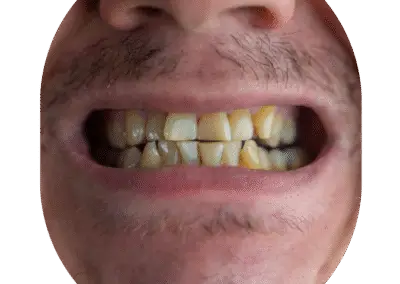Full Mouth makeover