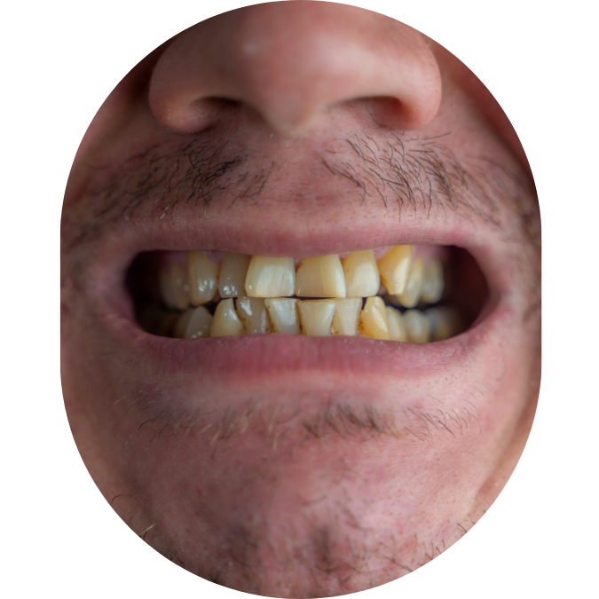 jaw pain,TMJ Treatment Mumbai,tmj specialist,TMJ Pain Specialist Kandivali,Jaw Pain Treatment Mumbai,Clicking jaw treatment Kandivali,Facial pain specialist,tekscan