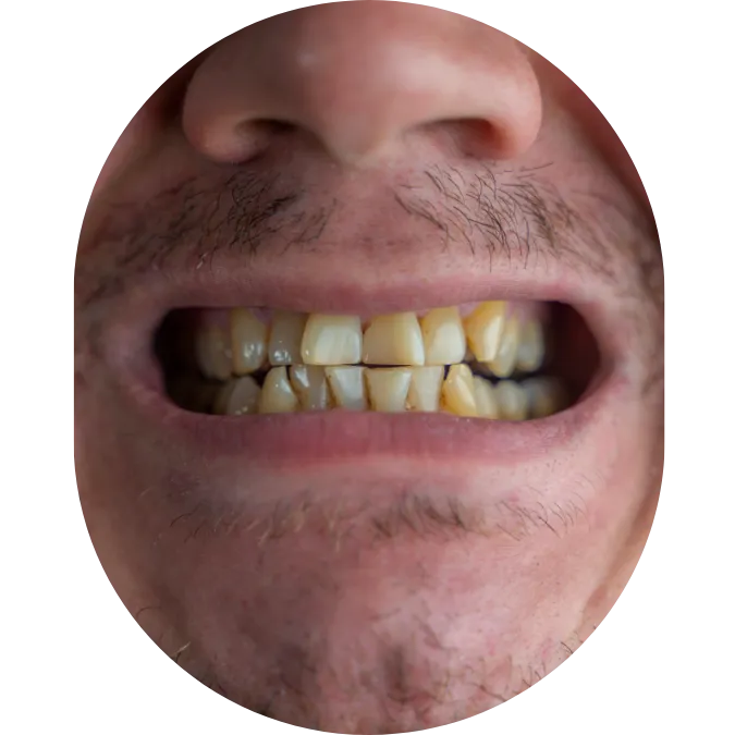 Full Mouth Full Mouth makeover