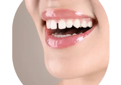 Smile Correction