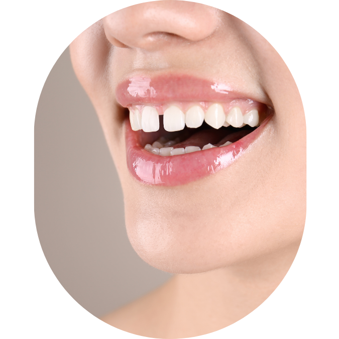 jaw pain,TMJ Treatment Mumbai,tmj specialist,TMJ Pain Specialist Kandivali,Jaw Pain Treatment Mumbai,Clicking jaw treatment Kandivali,Facial pain specialist,tekscan