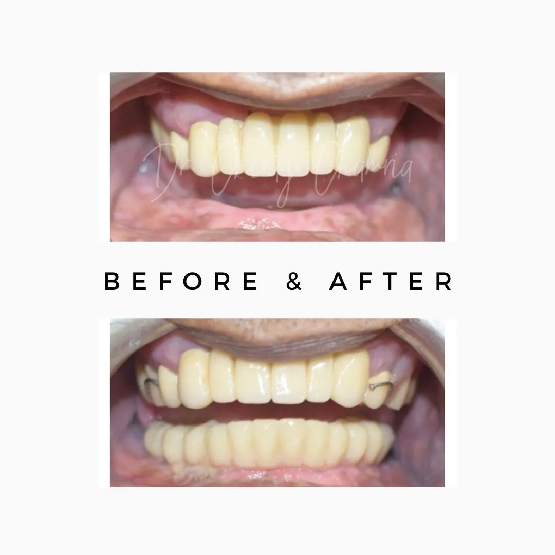 Full Mouth Implant,full mouth Implants Mumbai,Implant Specialist Kandivali,Implant Surgeon Mumbai,Full mouth rehabilitation,full mouth makeover