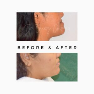 Jaw Correction Treatment