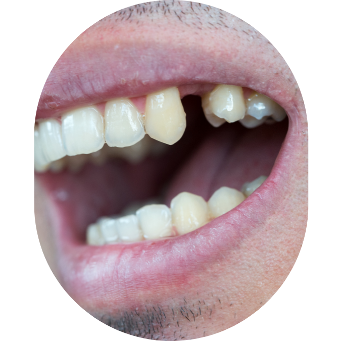 jaw pain,TMJ Treatment Mumbai,tmj specialist,TMJ Pain Specialist Kandivali,Jaw Pain Treatment Mumbai,Clicking jaw treatment Kandivali,Facial pain specialist,tekscan