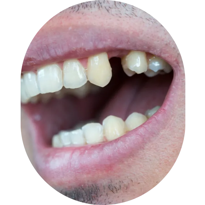 Missing Teeth Single dental implant