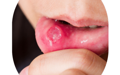 Mouth Cancer Treatment in India