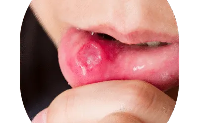Mouth Cancer Treatment in India