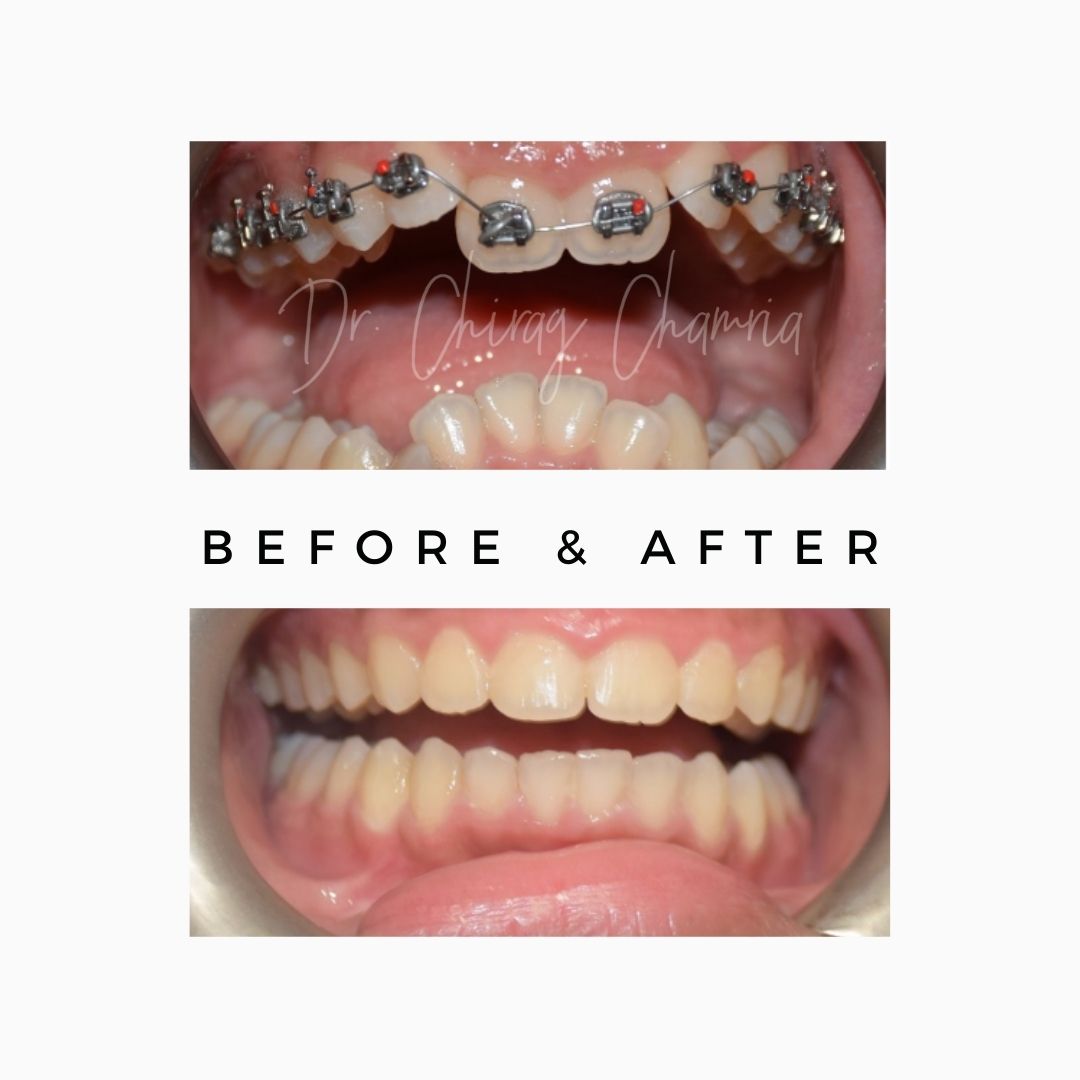Orthodontic Correction