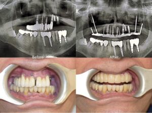 FMR with Zygoma Implant