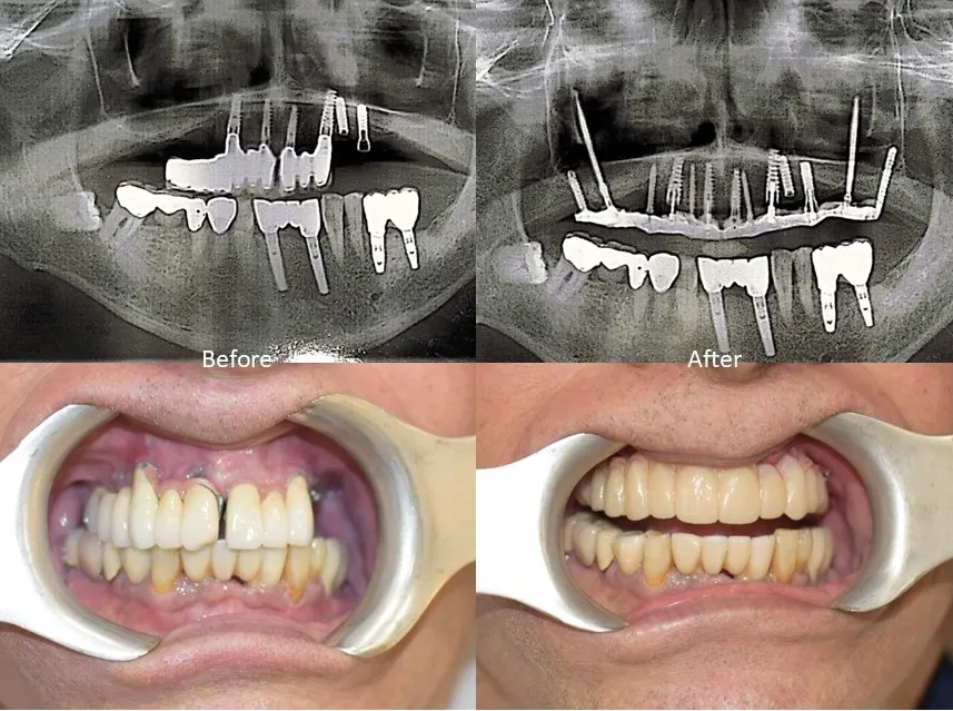 zygomatic dental implants,Zygomatic Implants Mumbai,Zygomatic Implant Specialist,Zygoma Implant Surgeon Mumbai,No bone dental implants Mumbai,Dental implants without bone graft Mumbai,zygoma bone,zygomatic bone,bone loss