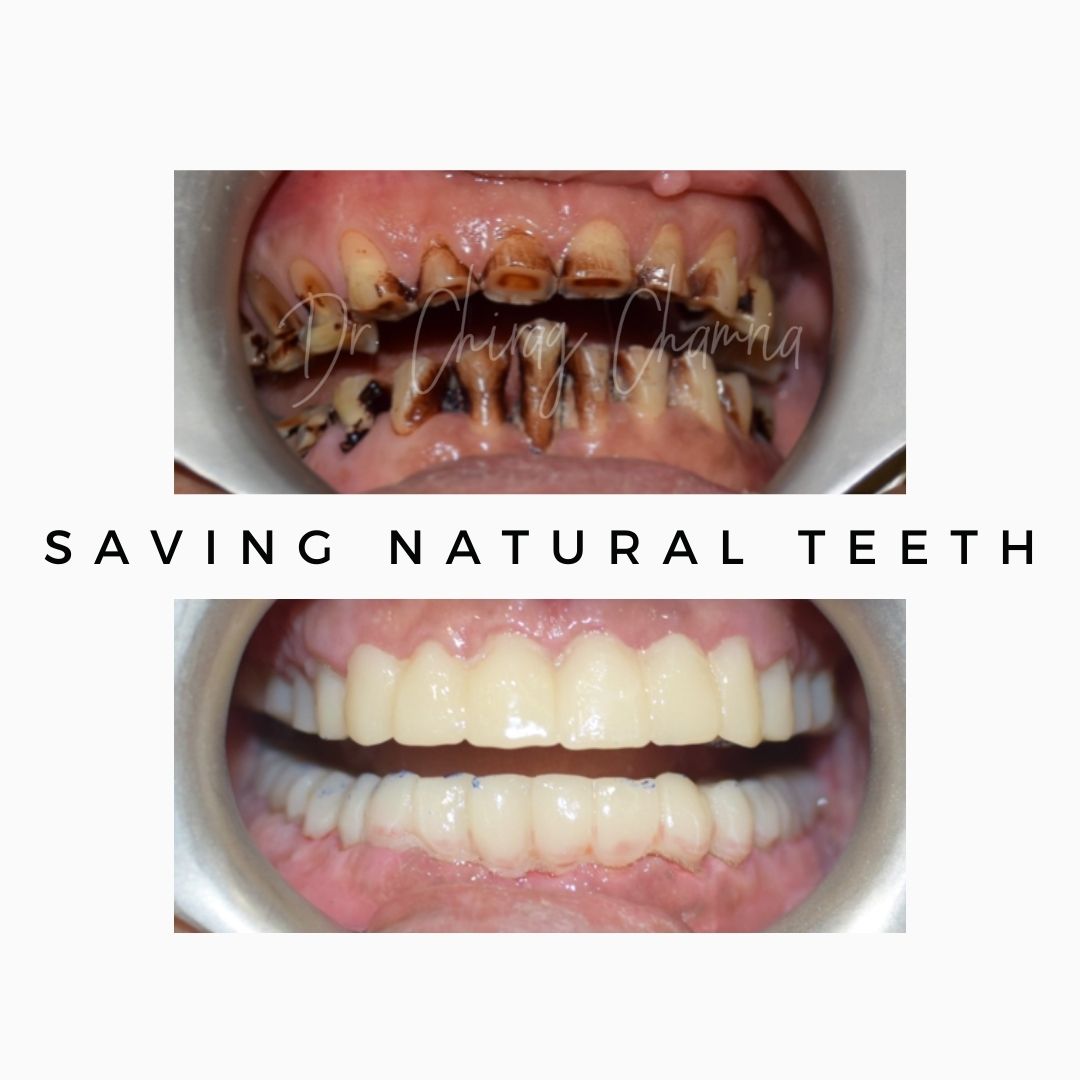 Saving Natural Teeth