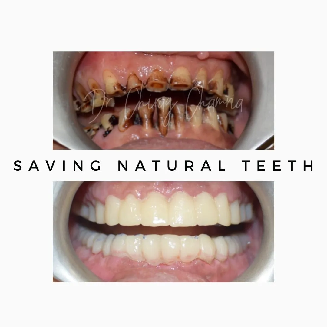 Saving Natural Teeth Saving Natural Teeth