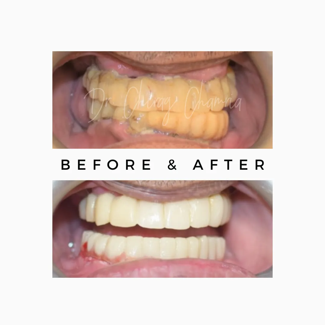 zygomatic dental implants,Zygomatic Implants Mumbai,Zygomatic Implant Specialist,Zygoma Implant Surgeon Mumbai,No bone dental implants Mumbai,Dental implants without bone graft Mumbai,zygoma bone,zygomatic bone,bone loss