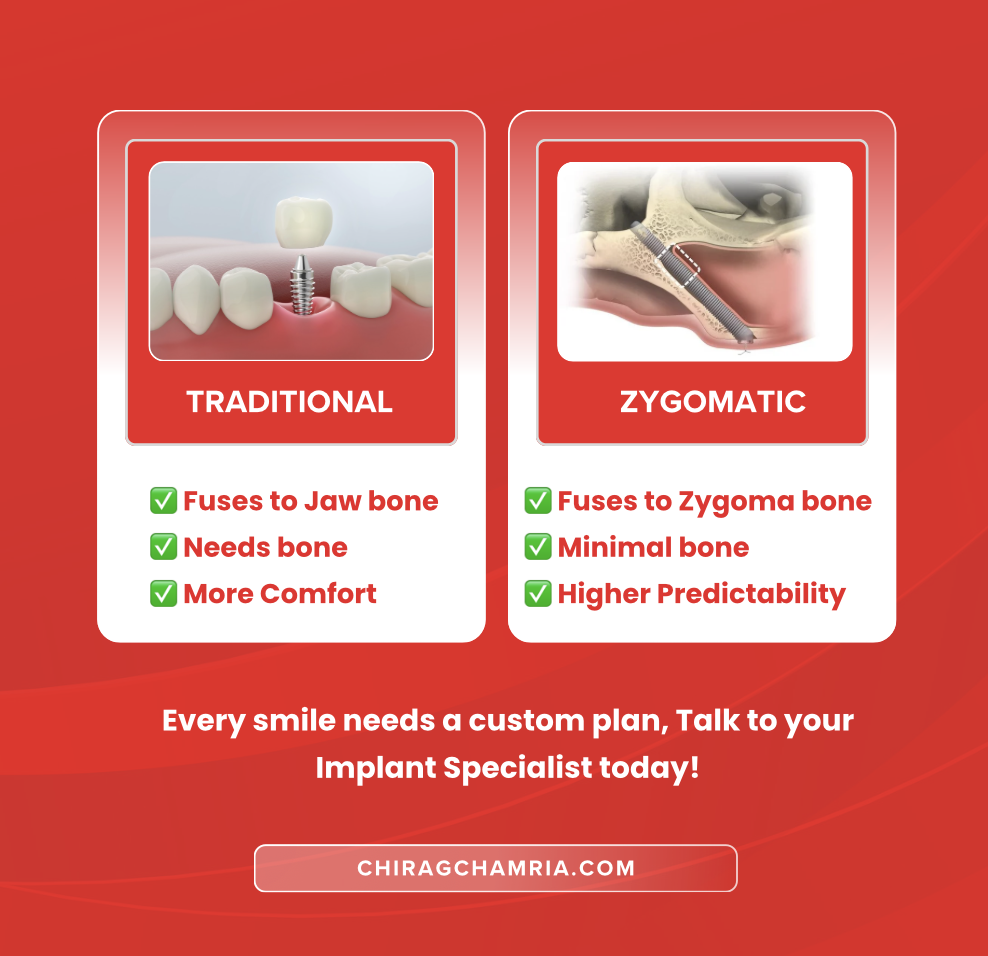 Difference between Zygomaticn Implant and Traditional