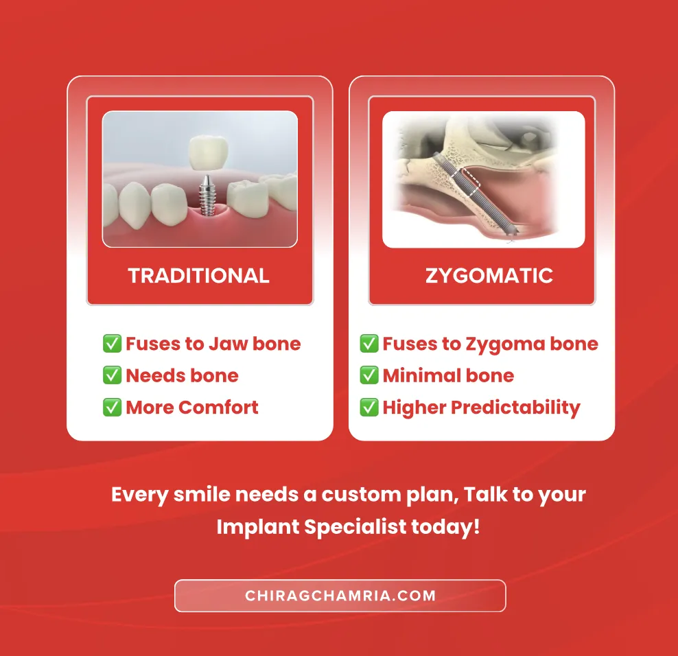 Difference between Zygomaticn Implant and Traditional