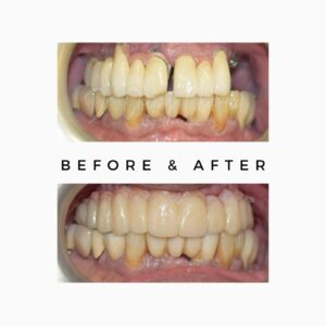 zygomatic dental implants,Zygomatic Implants Mumbai,Zygomatic Implant Specialist,Zygoma Implant Surgeon Mumbai,No bone dental implants Mumbai,Dental implants without bone graft Mumbai,zygoma bone,zygomatic bone,bone loss