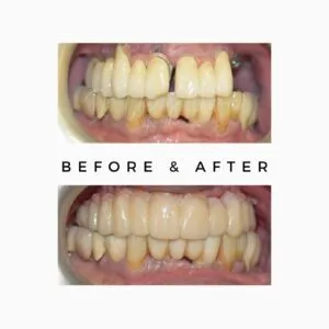 zygomatic dental implants,Zygomatic Implants Mumbai,Zygomatic Implant Specialist,Zygoma Implant Surgeon Mumbai,No bone dental implants Mumbai,Dental implants without bone graft Mumbai,zygoma bone,zygomatic bone,bone loss