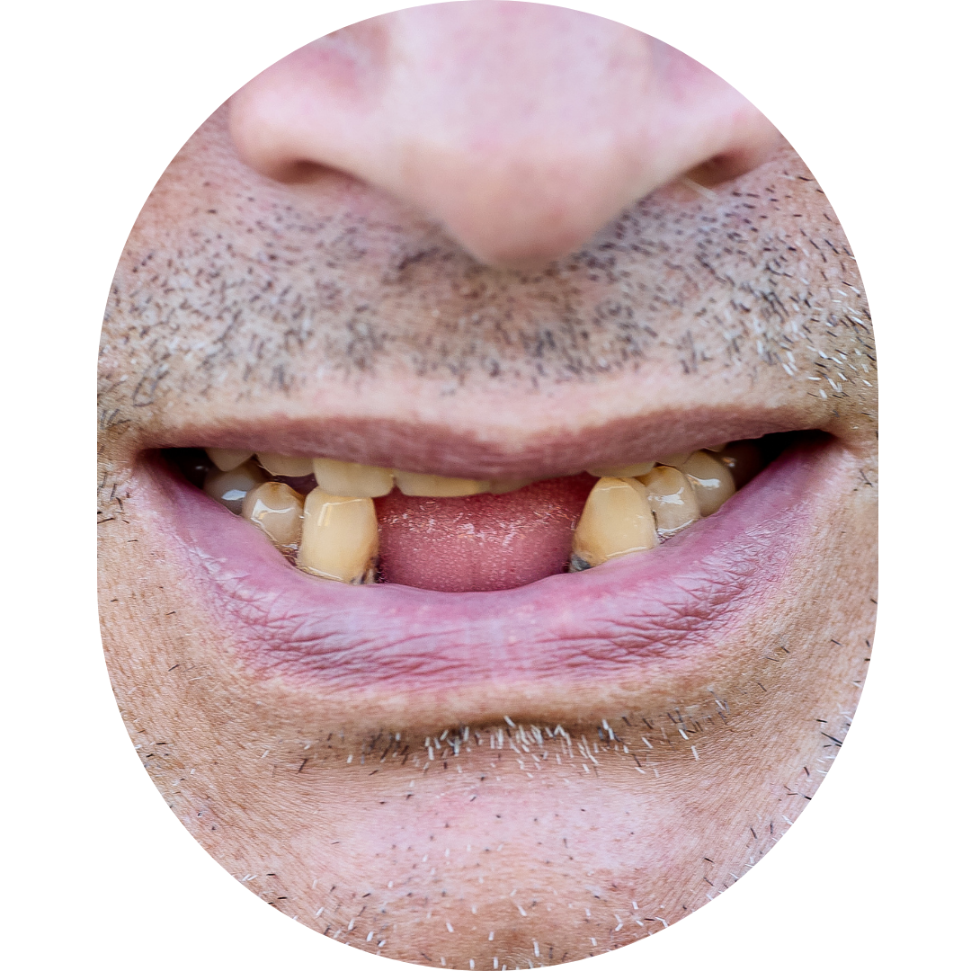 jaw pain,TMJ Treatment Mumbai,tmj specialist,TMJ Pain Specialist Kandivali,Jaw Pain Treatment Mumbai,Clicking jaw treatment Kandivali,Facial pain specialist,tekscan