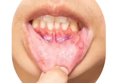 Top Rated Oral Surgeon for Ulcers
