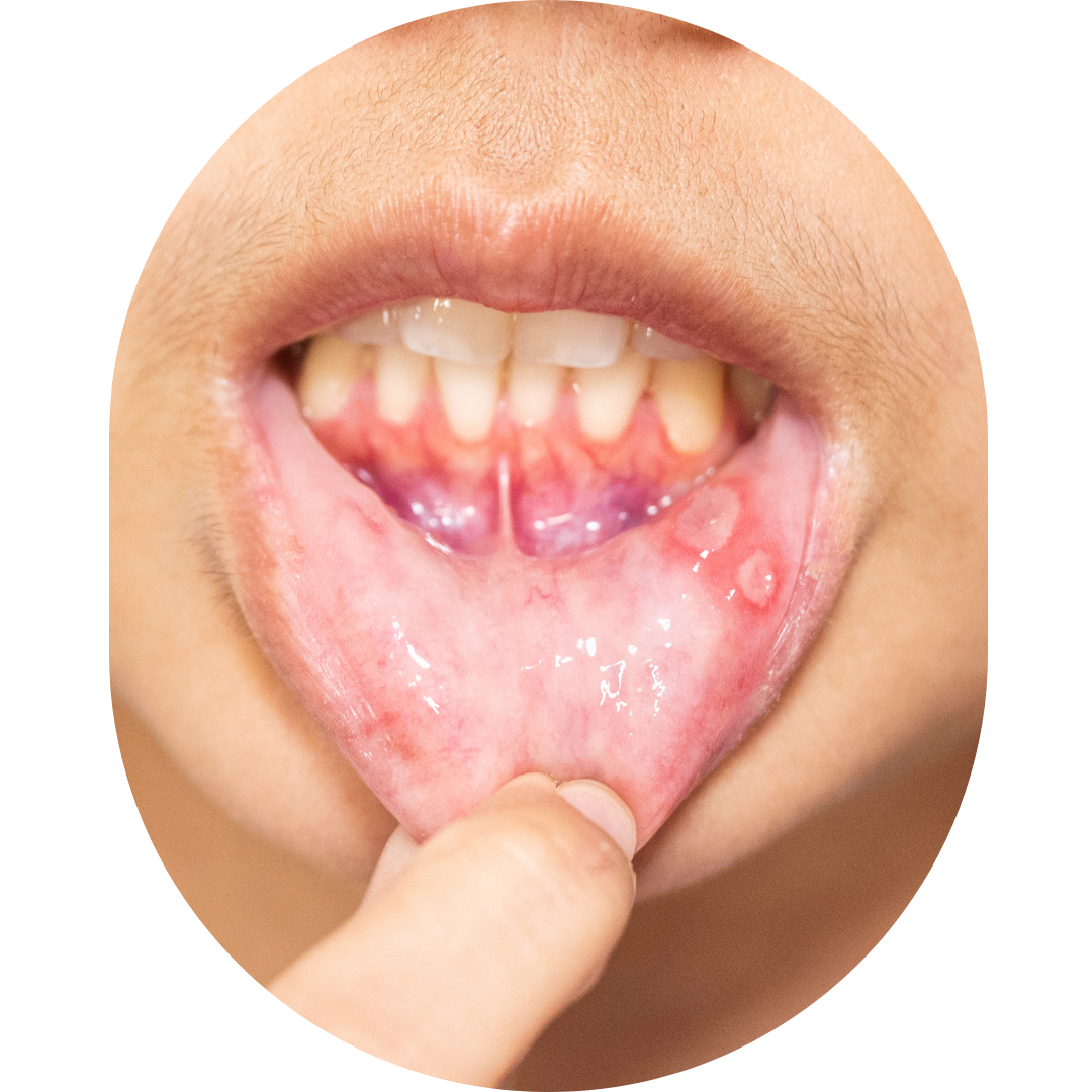 jaw pain,TMJ Treatment Mumbai,tmj specialist,TMJ Pain Specialist Kandivali,Jaw Pain Treatment Mumbai,Clicking jaw treatment Kandivali,Facial pain specialist,tekscan