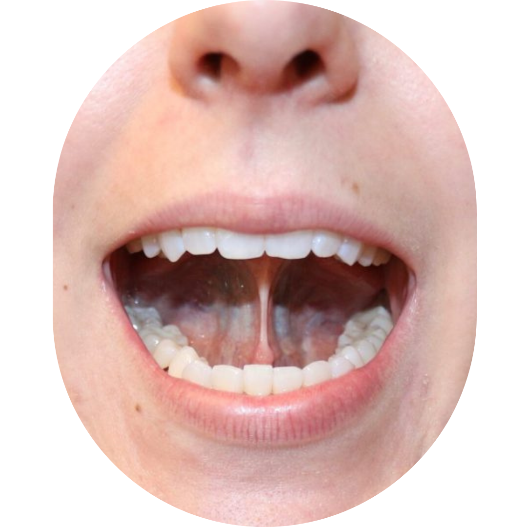 jaw pain,TMJ Treatment Mumbai,tmj specialist,TMJ Pain Specialist Kandivali,Jaw Pain Treatment Mumbai,Clicking jaw treatment Kandivali,Facial pain specialist,tekscan