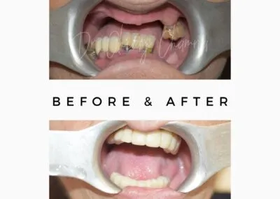 Less or no bone implant specialist in Mumbai