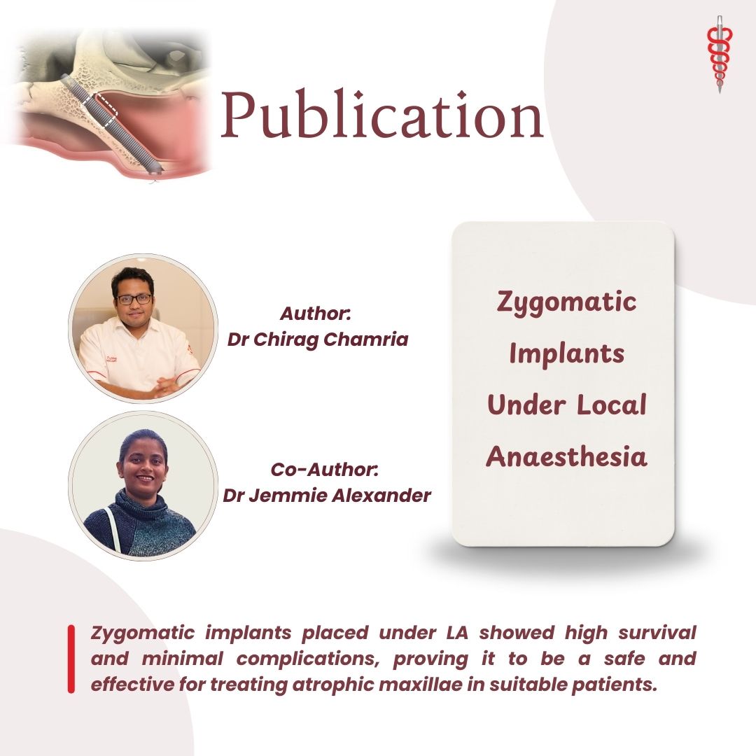 Research Publication: Zygomatic Implant