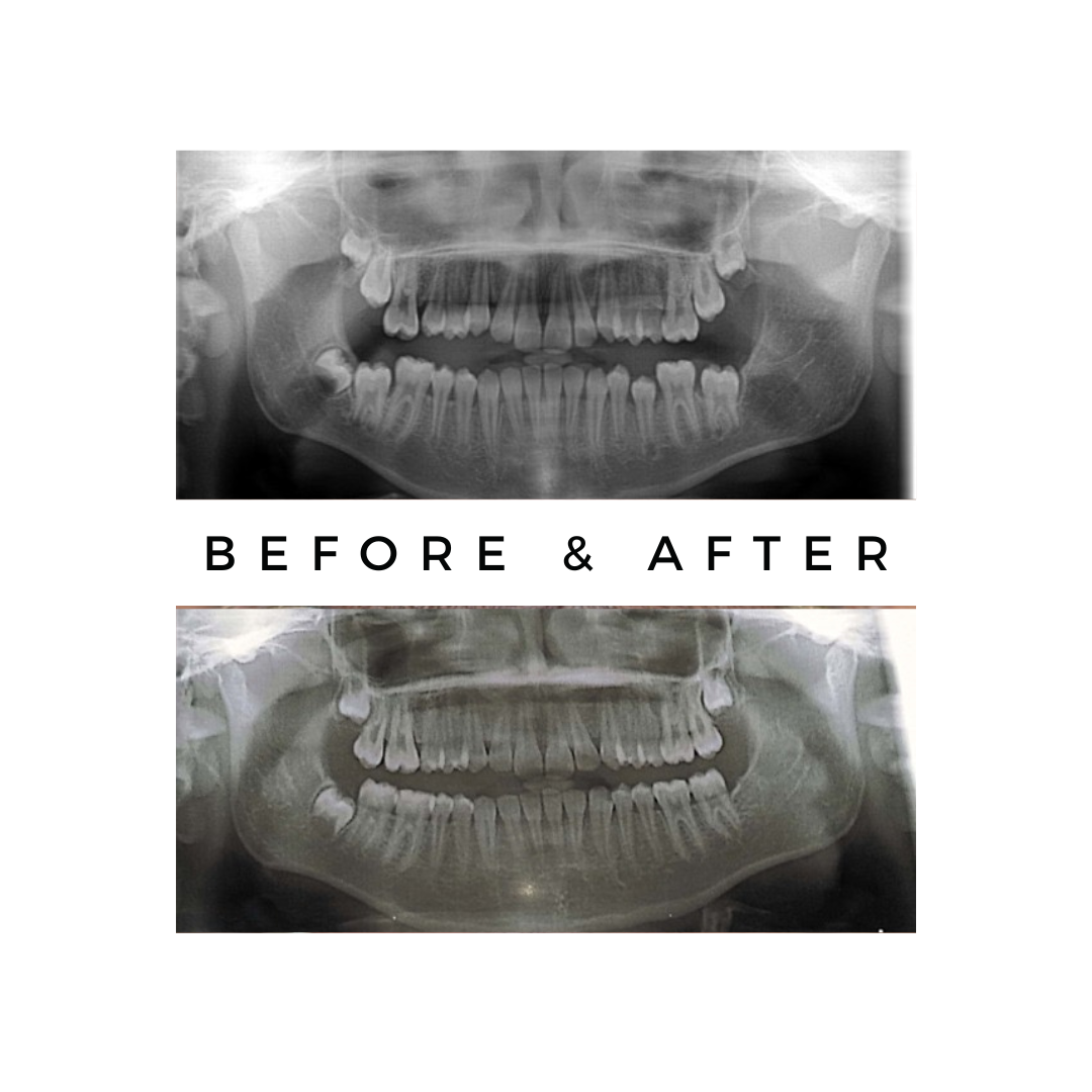 oral cancer,cancer treatment,Oral Cancer Surgeon Mumbai,Jaw Reconstruction After Cancer Mumbai,Cancer Rehabilitation Dentist Kandivali,Teeth after cancer surgery Mumbai,CAJTeeth,oral cancer teeth