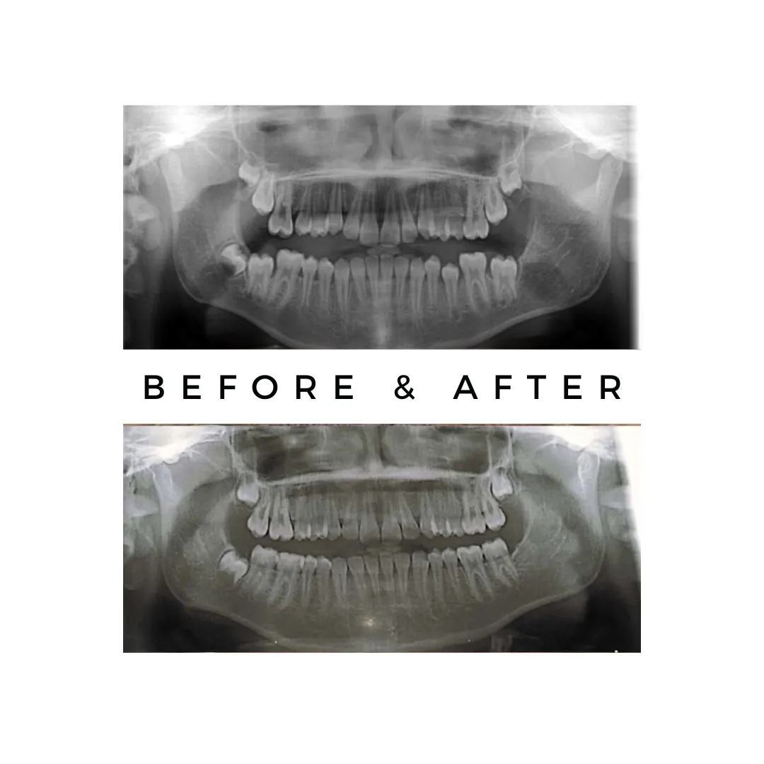 oral surgery,orthognathic surgery,Jaw Surgery Specialist Mumbai,Underbite surgery Mumbai,jaw alignment surgery,wisdom tooth,dental extraction,jaw pain in mumbai,oral surgeon,oral cyst
