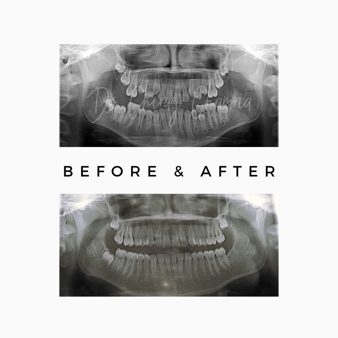 Dental Last Tooth Extract - Third Molar
