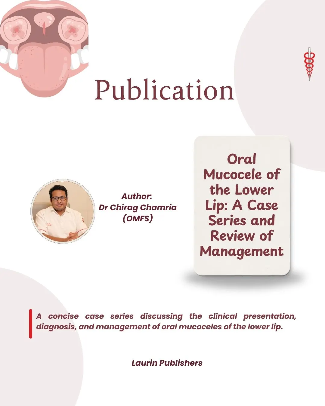 Dr Chirag Publication - Oral Mucocele in Lower Lip