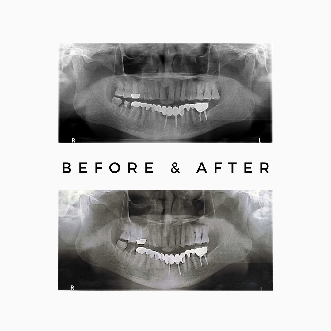 wisdom tooth, tooth extraction, third molar, tooth removal, Wisdom Tooth Removal Kandivali, Impacted Tooth Surgery Mumbai, Tooth Extraction Surgeon Mumbai, Painless tooth extraction