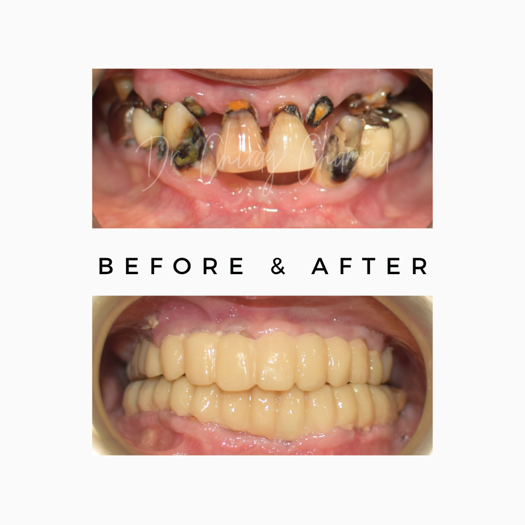 loose or mobile teeth