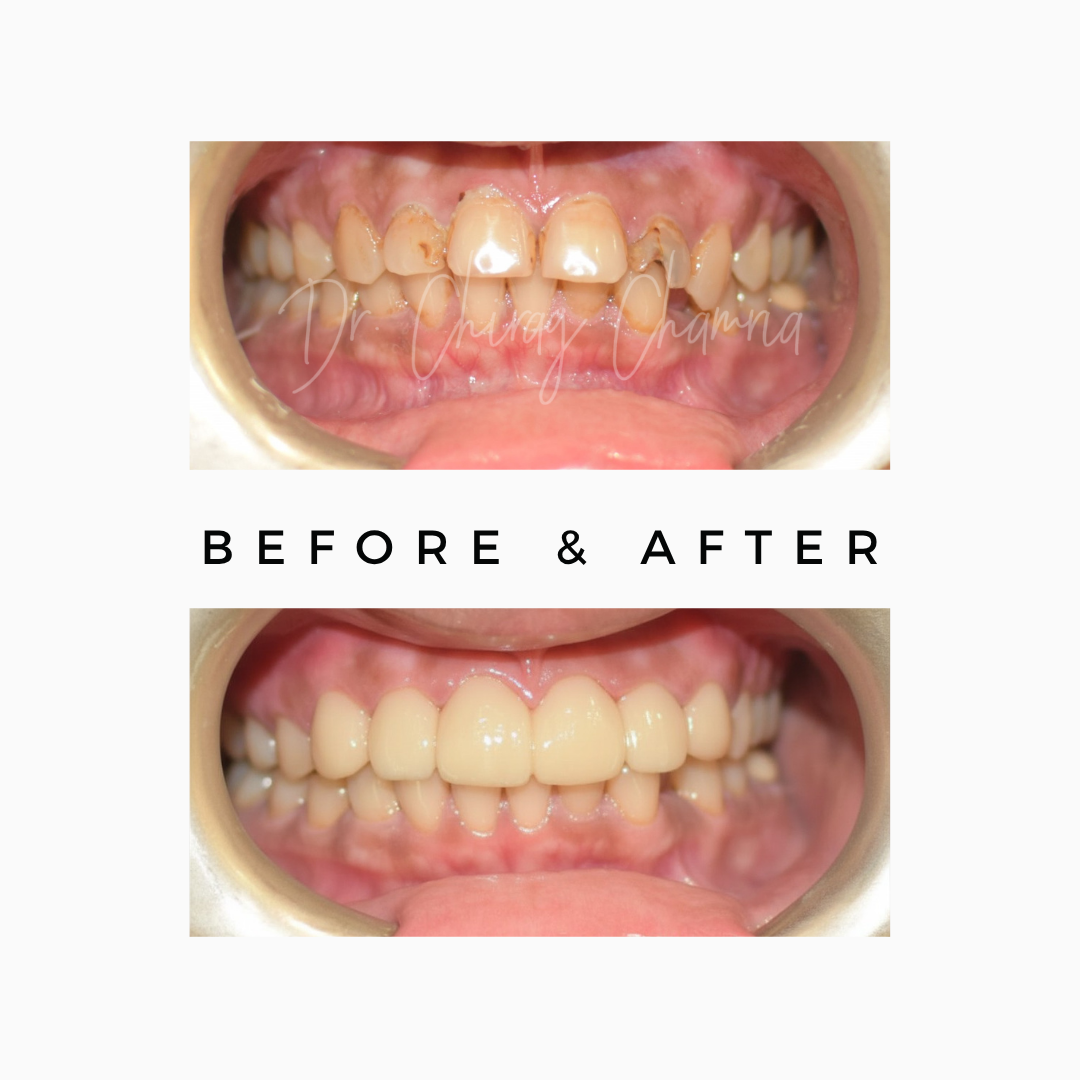 dental veneers Mumbai