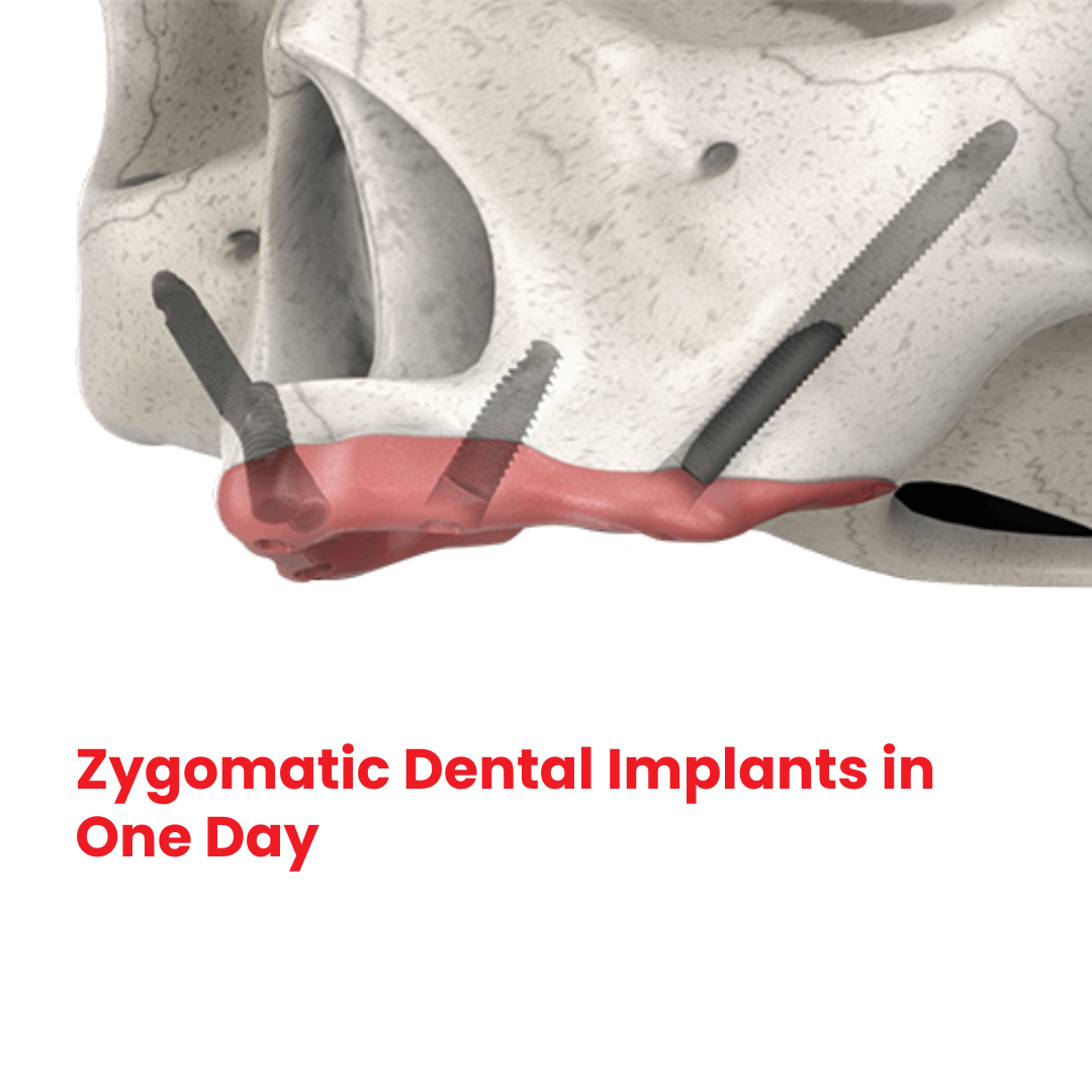 Zygomatic Implants Mumbai