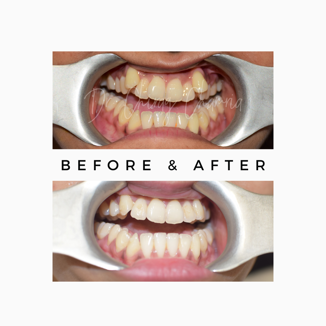 Crooked Teeth Correction after Orthognathic Surgery